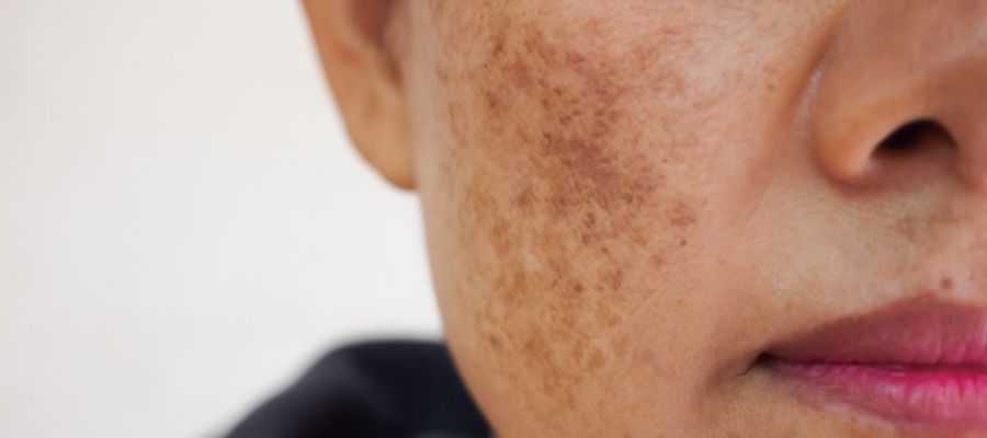 Lady with Pigmentation and dark spots