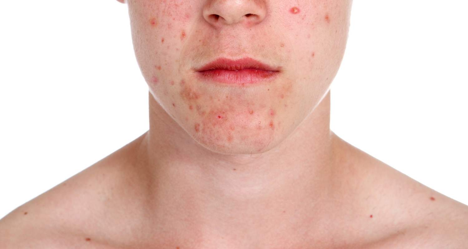 Teenager with acne