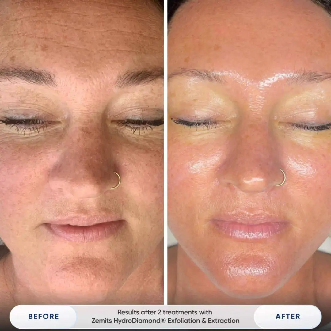 Zemits Verstand HD Pro High-Tech 8-in-1 HydroDiamond® Platform