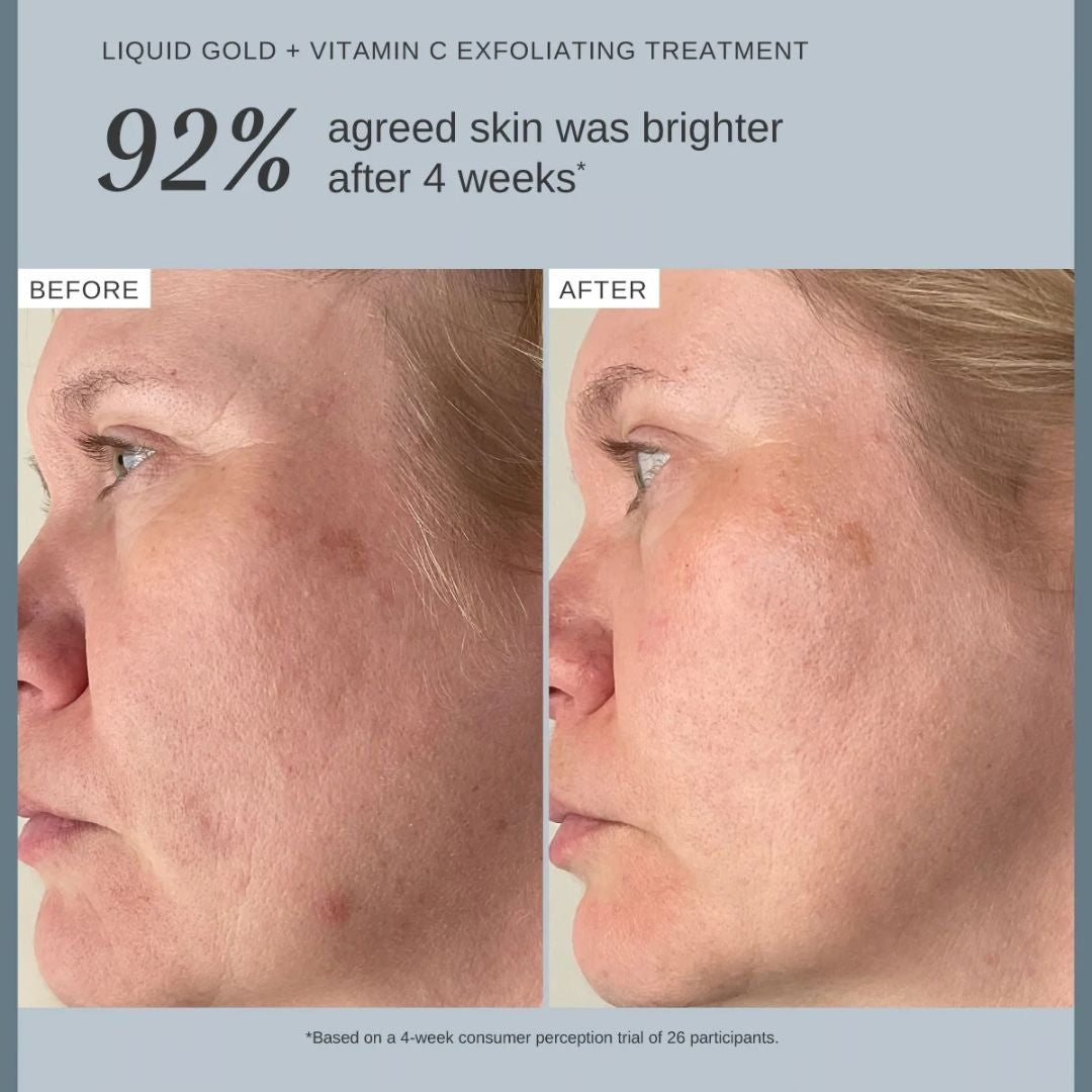 Alpha-H Liquid Gold + Vitamin C Exfoliating Treatment before and after showing brighter-looking skin after 4 weeks