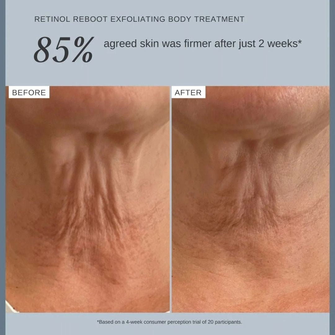 Alpha-H Retinol Reboot Exfoliating Body Treatment before and after showing firmer-looking skin after two weeks