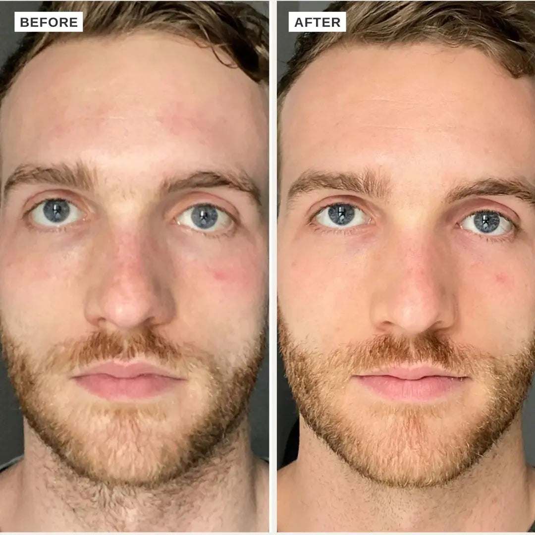 Before and after comparison of a man's face after using Alpha H Vitamin B Serum