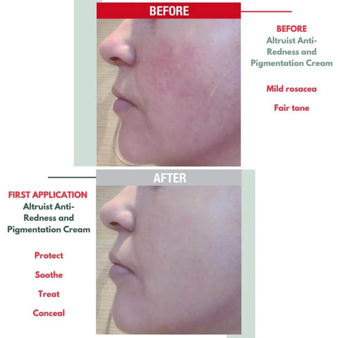 Altruist Dermatologist Anti-Redness and Pigmentation SPF 50 30ml – before and after: redness and pigmentation visibly reduced after regular use