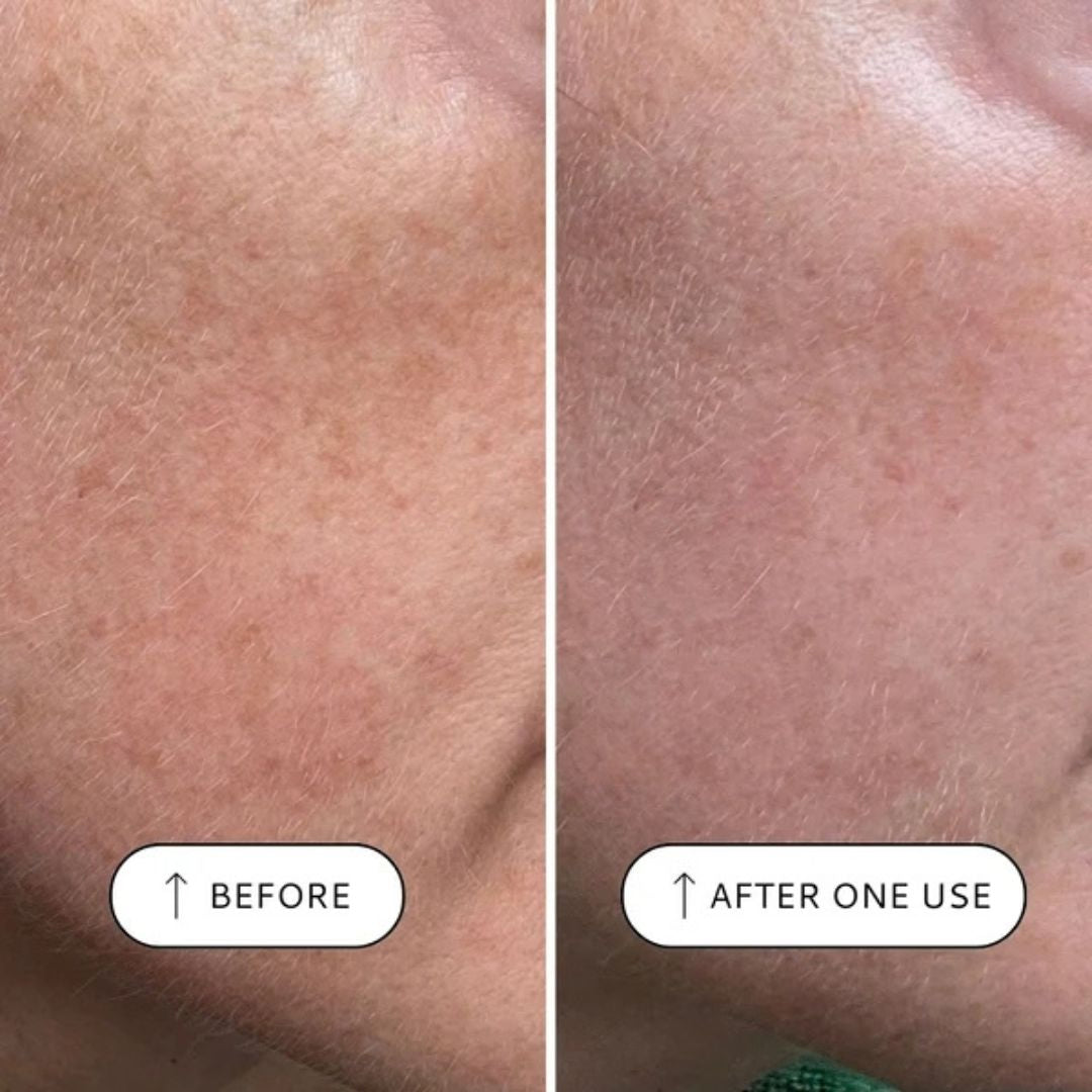 Votary Sensitive Resurfacing Peel before and after one use showing visibly smoother and refined-looking skin texture