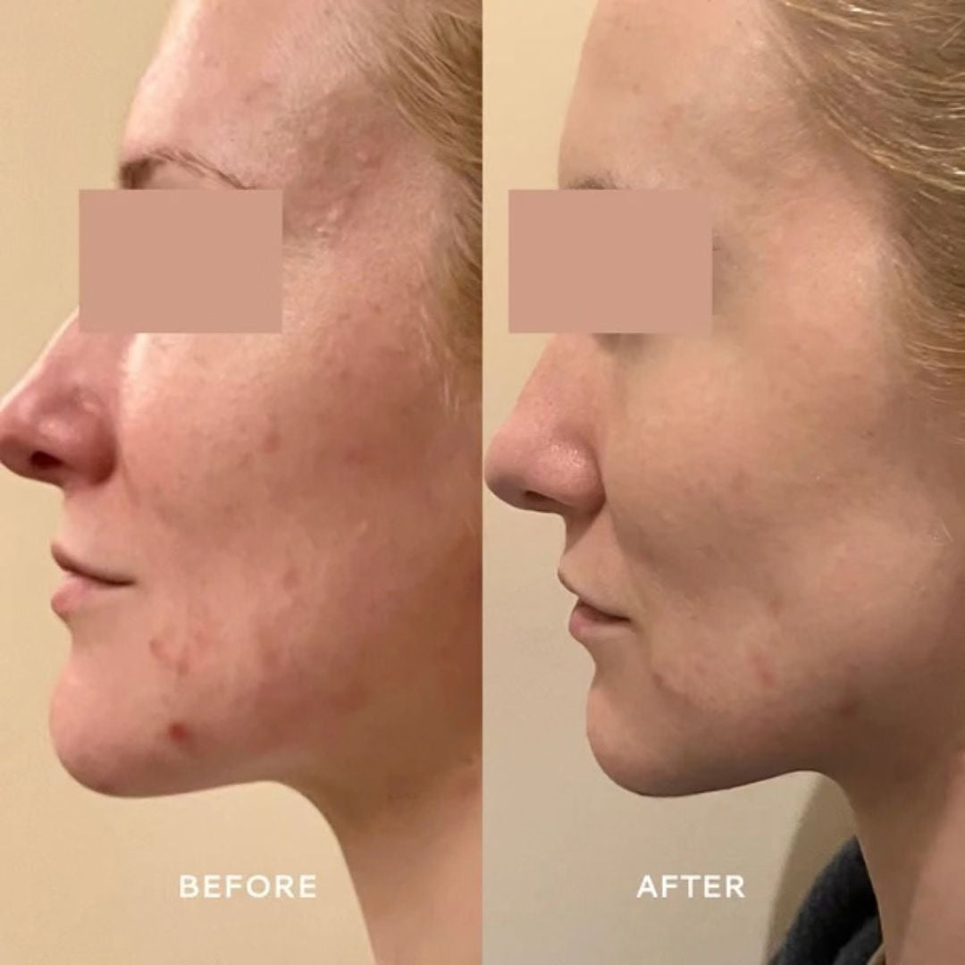 Votary Super Barrier Balm before and after showing the appearance of calmer, smoother-looking skin