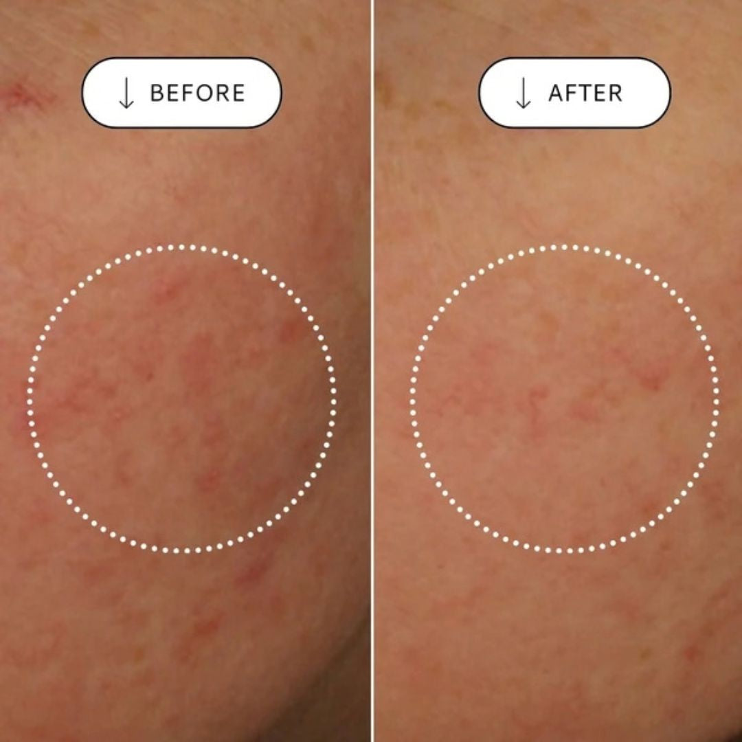 Votary Super Seed Serum before and after showing visibly calmer-looking skin with reduced appearance of rednes