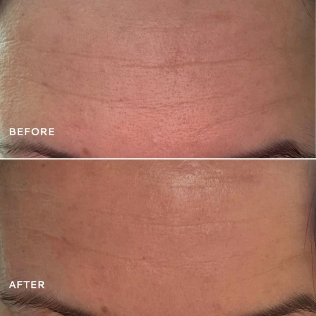 Votary Ultimate Light Cream before and after showing smoother-looking forehead skin and visibly softened fine lines