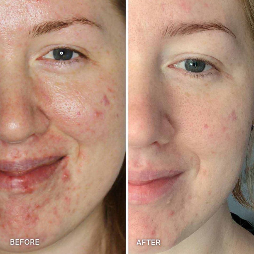 Teenager Skin and face