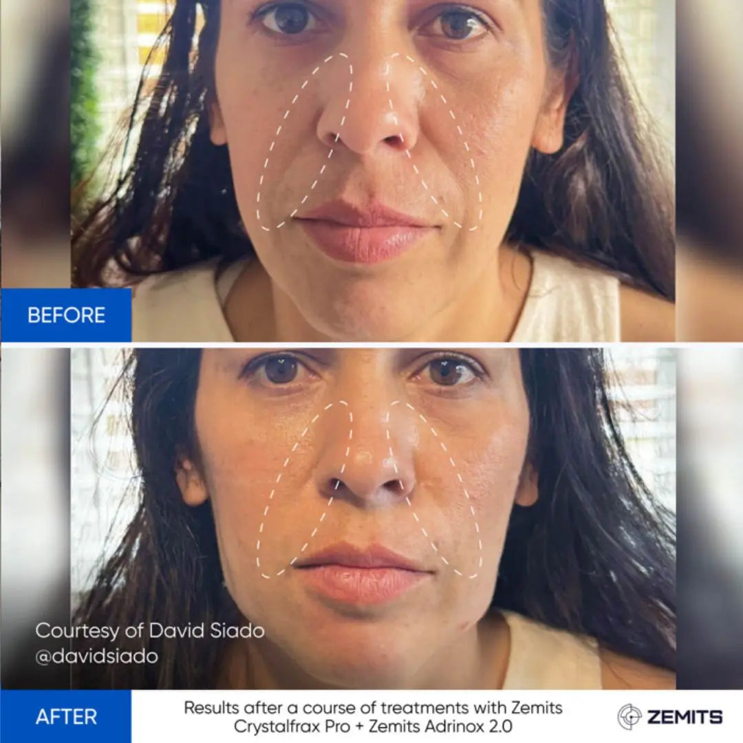 Zemits Zemits Adrinox 2.0