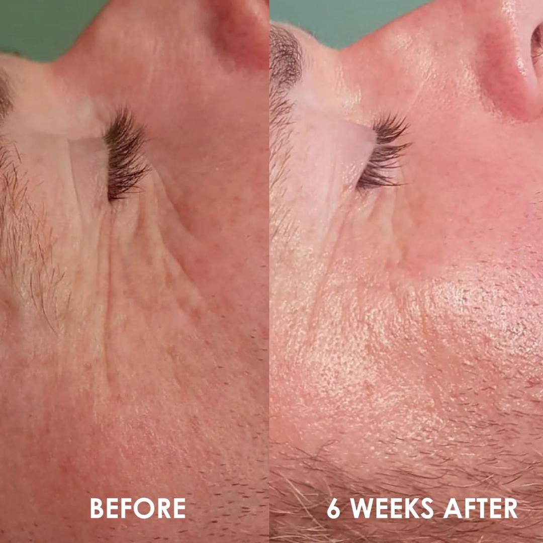 Humanity Eye Restore Before and After