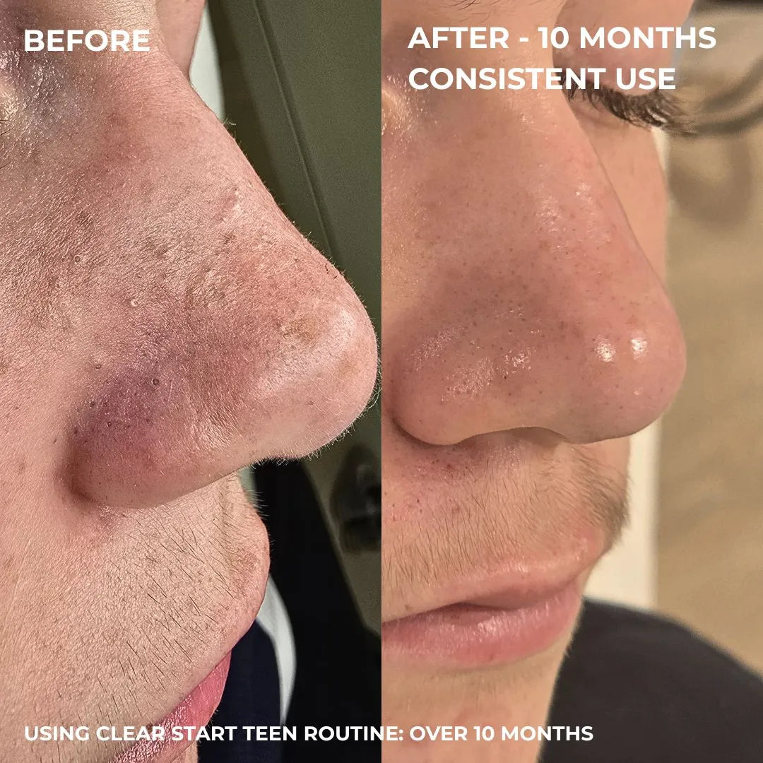 Alpha-H Clear Start Teen Routine - 12+ years