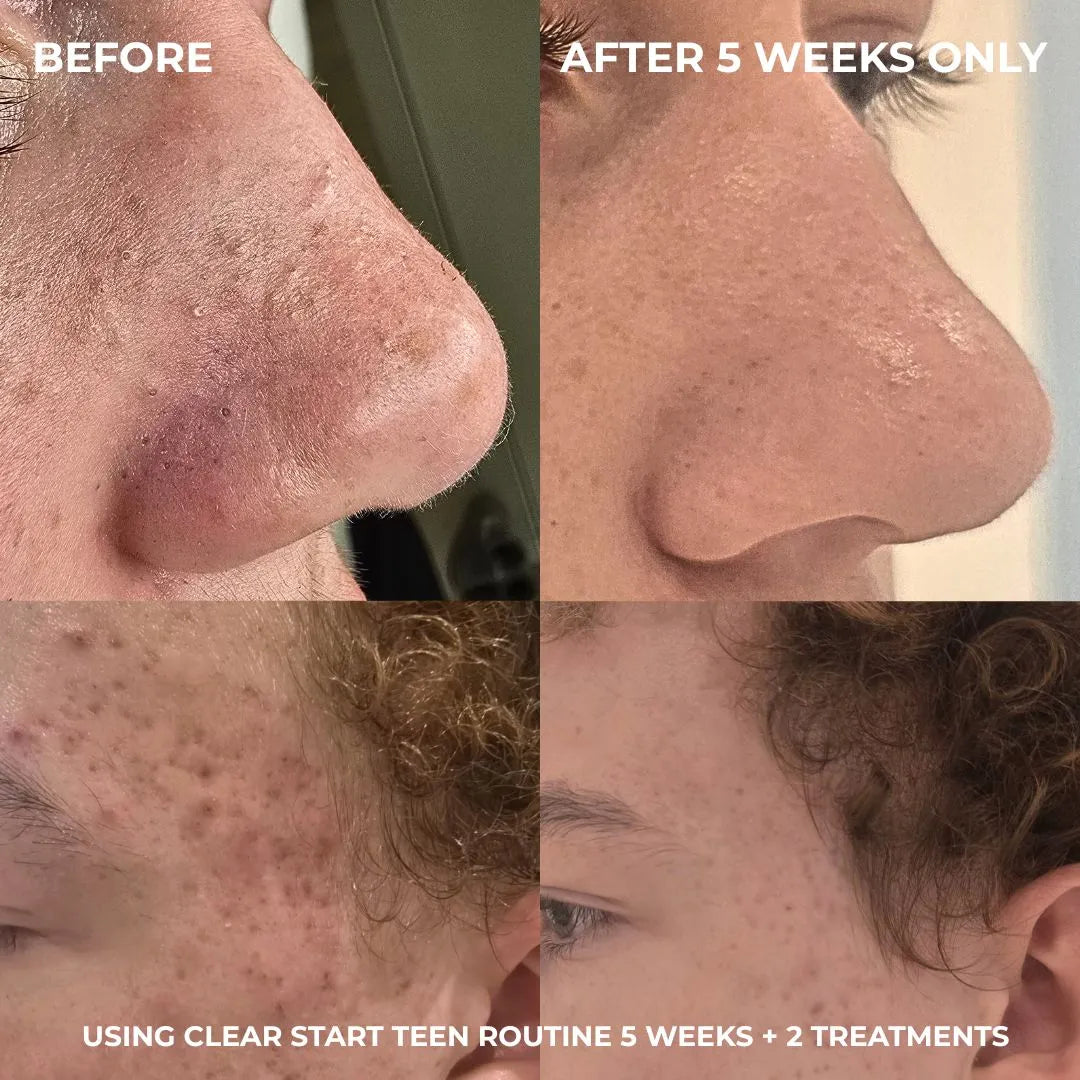 Alpha-H Clear Start Teen Routine - 12+ years