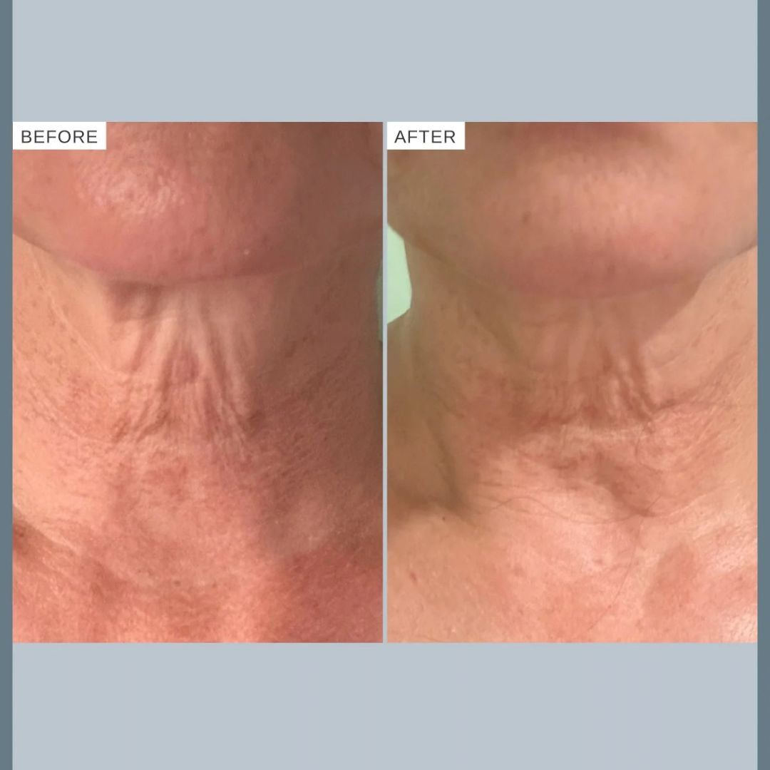 Alpha-H Firming Peptide Body Oil before and after showing the appearance of neck skin and fine lines