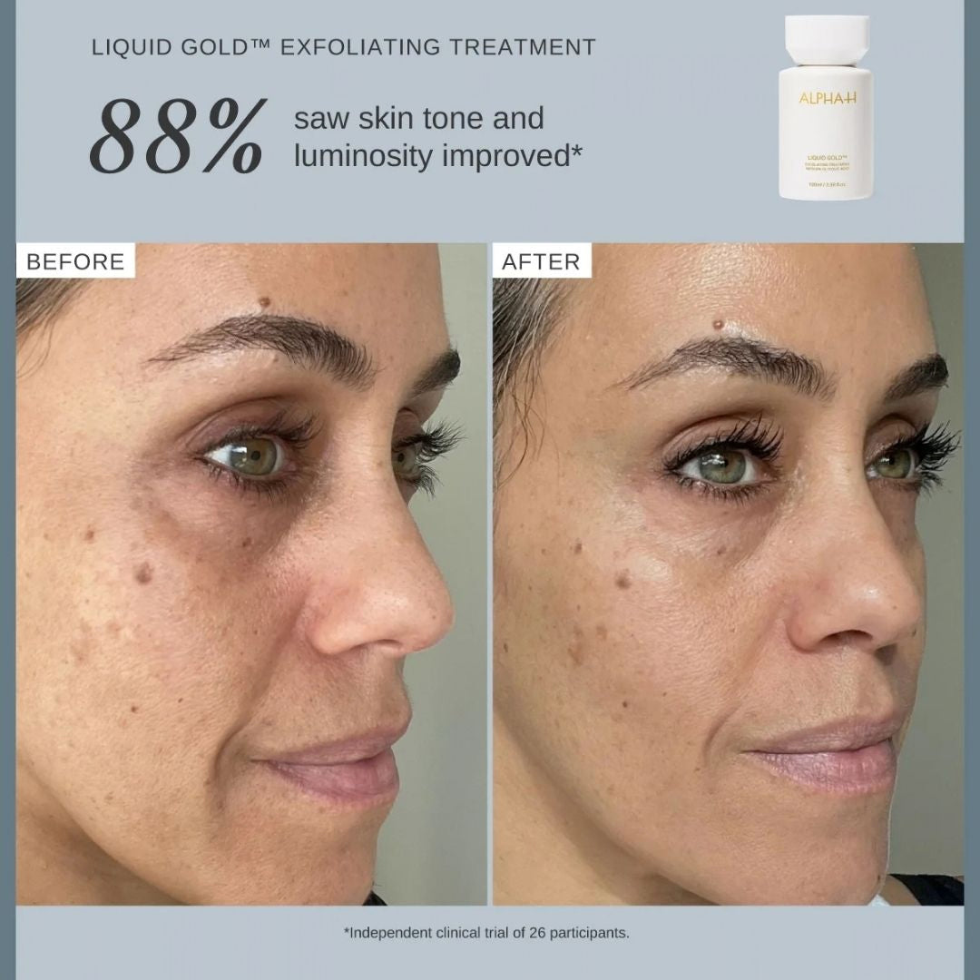 Alpha-H Liquid Gold before and after showing improved skin tone 88% saw skin tone and luminosity improved and luminosity with 5% glycolic acid exfoliating treatment