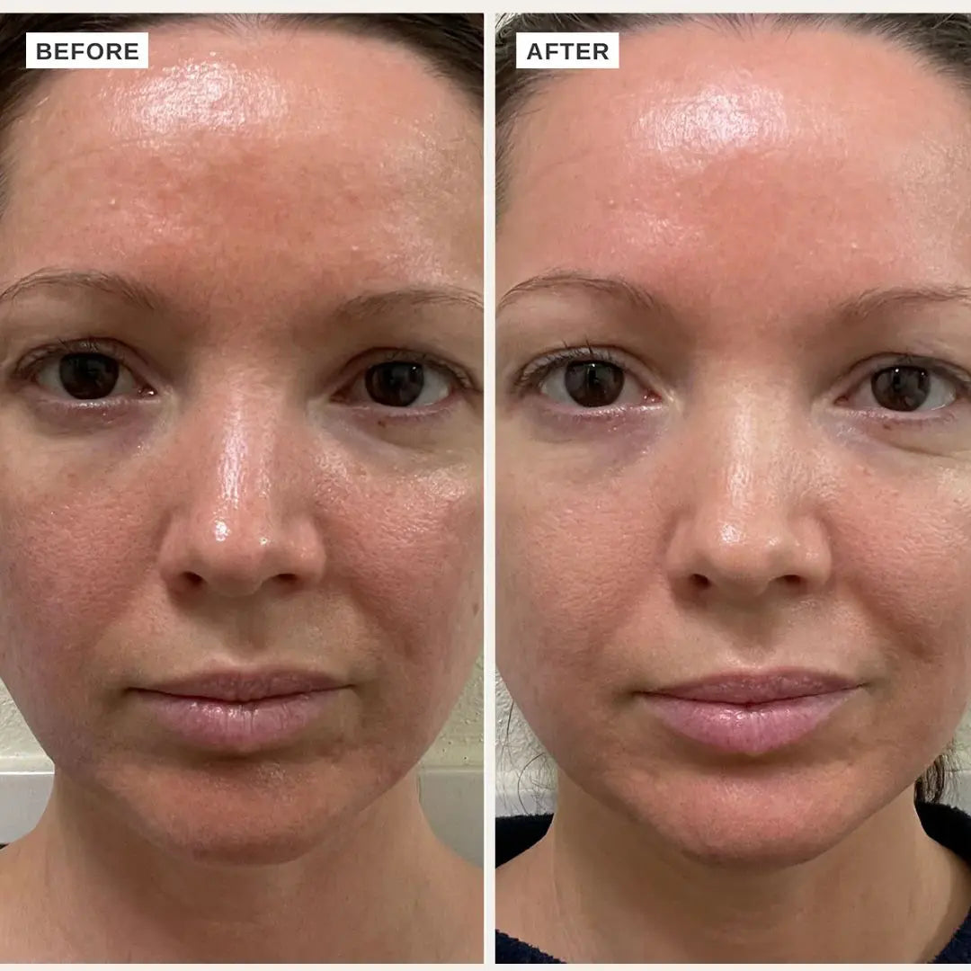 Before and after comparison of a woman's face with visible skin  improvement after using Alpha H Vitamin B Serum