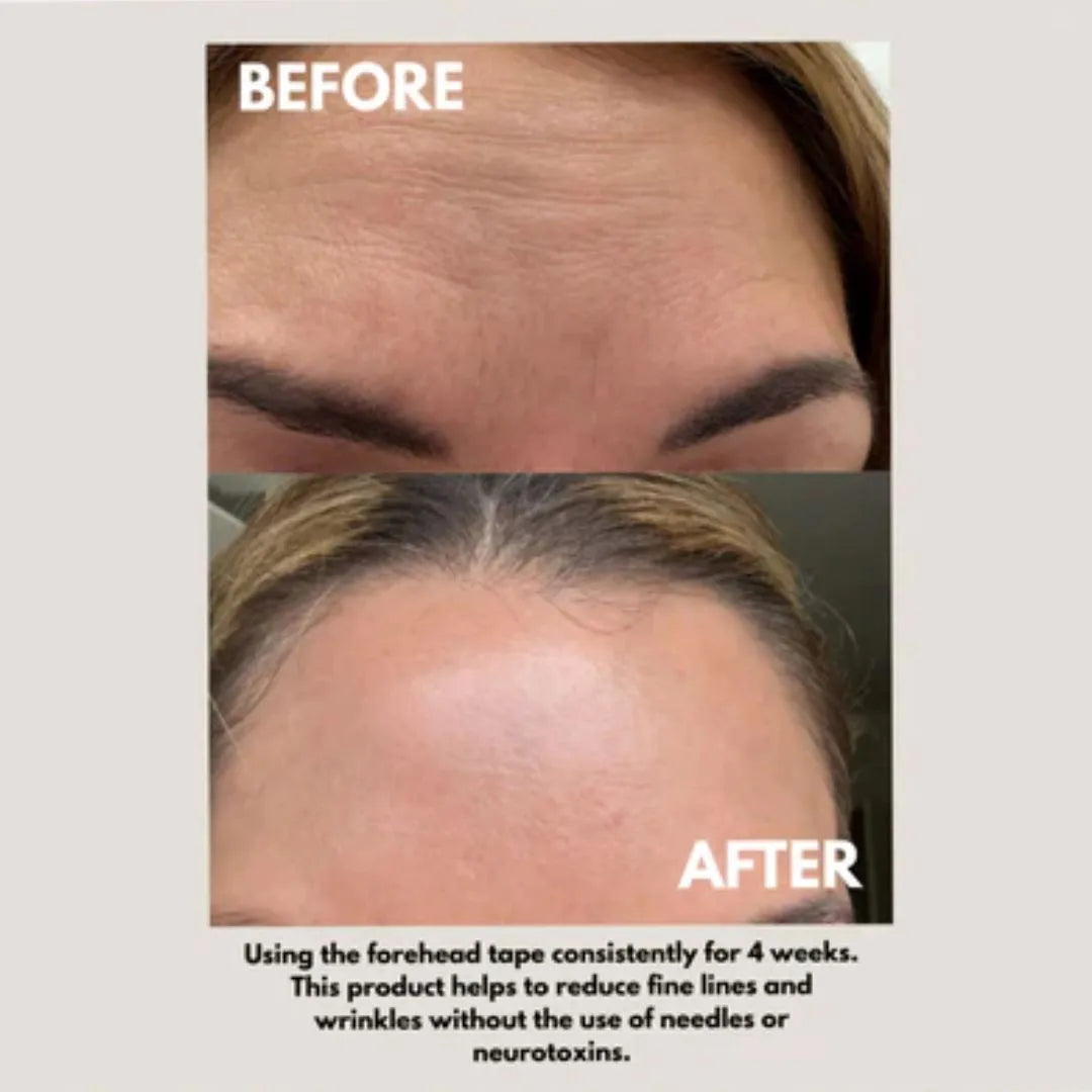 Seald™ Forehead Tape – Wrinkle Smoothing Patches