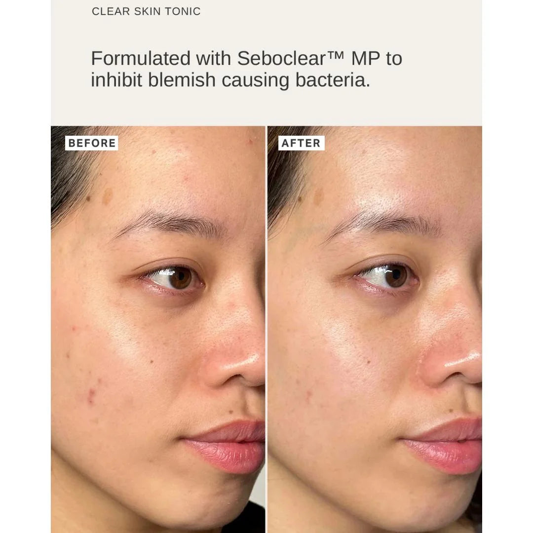 Alpha-H Clear Skin Tonic 2% BHA Salicylic with Seboclear 100ml – clinical results infographic: reduced blemishes and sebum production