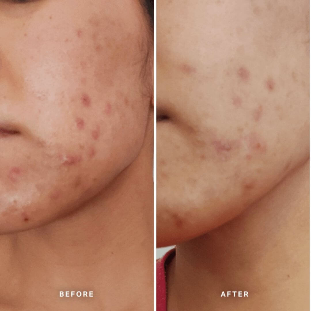 Alpha H Clear Skin Tonic Before and After