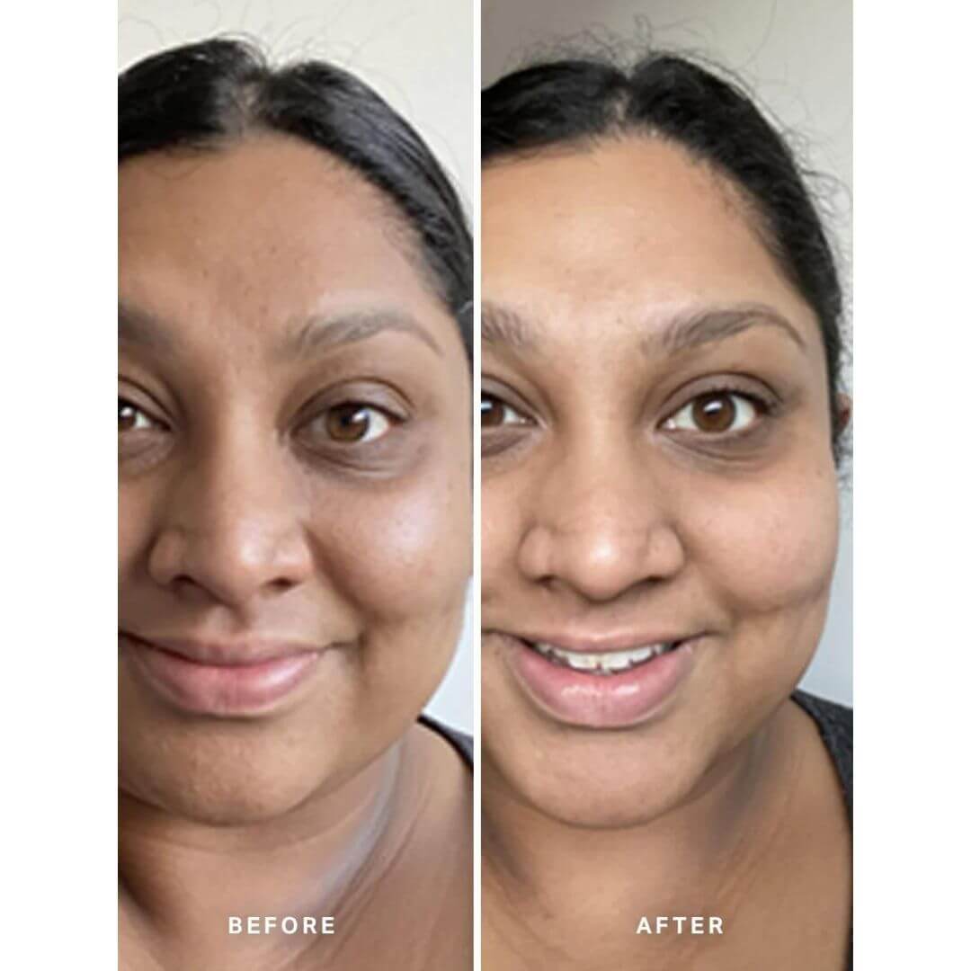 Pigmentation Duo Before And After